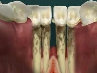 Fáze onemocnění parodontu 

 #teeth  #oralcare  #p…