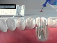 Už jste se setkali s pojmem endodoncie? 🤔
Jedná se…